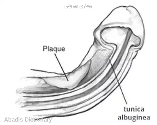 بیماری پیرونی